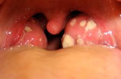 M_Mouth_Sub_Tonsillitis